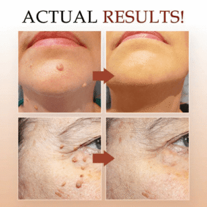 đBUY 1 GET 1 FREEđWipeOff⢠Tags & Moles Remover - Emporium Shop