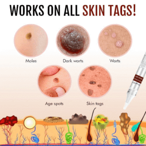 đBUY 1 GET 1 FREEđWipeOff⢠Tags & Moles Remover - Emporium Shop